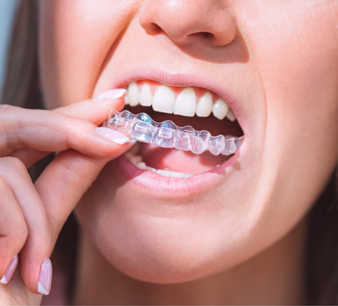 Woman placing an Invisalign aligner over her teeth