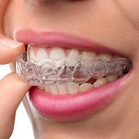 Closeup of patient placing Invisalign tray