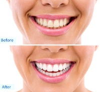 before and after images showing results of professional zoom teeth whitening Melrose, MA