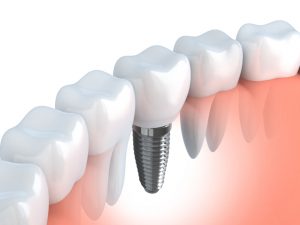 Smile gaps cause poor self-image and oral health. Learn about dental implants and bridges, choices for tooth replacement ar Brooks Dental in Boston.