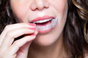 Benefit from braces in Boston for a healthy smile.