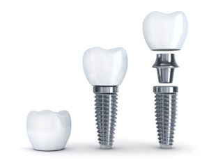 tooth replacement dental implant