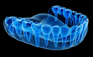 dental implant illustration