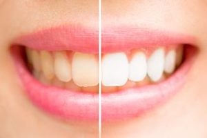 Smile before and after whitening