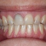 tooth discoloration