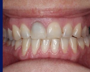 tooth discoloration