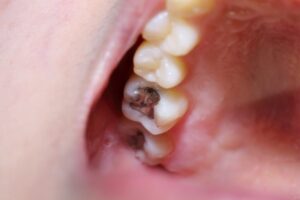closeup of an amalgam filling