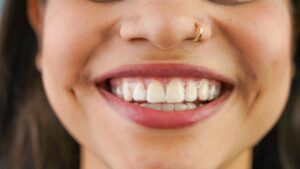 closeup of a smile with Invisalign aligners in 